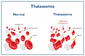 symptômes thalassémie