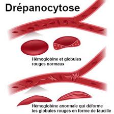 drépanocytose et thalassémie grossesse