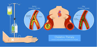 chelation