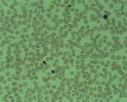 anemie beta thalassemie