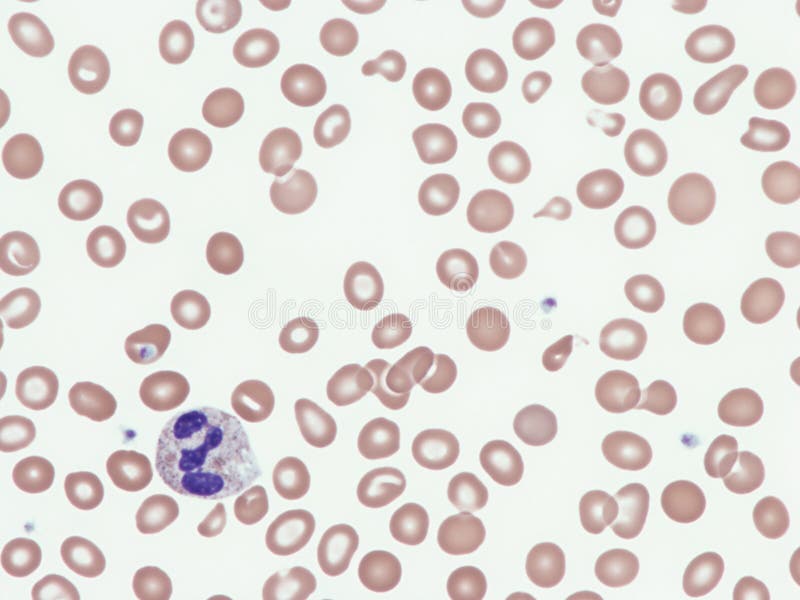 alfa talasemia que es